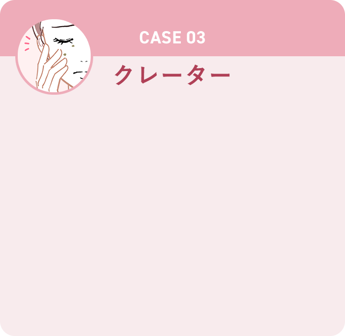 CASE03 クレーター