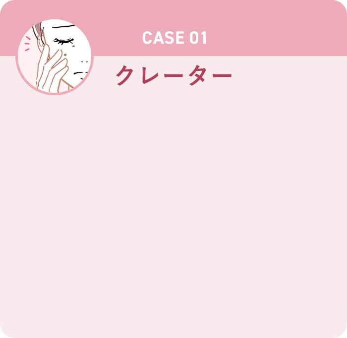 CASE03 クレーター