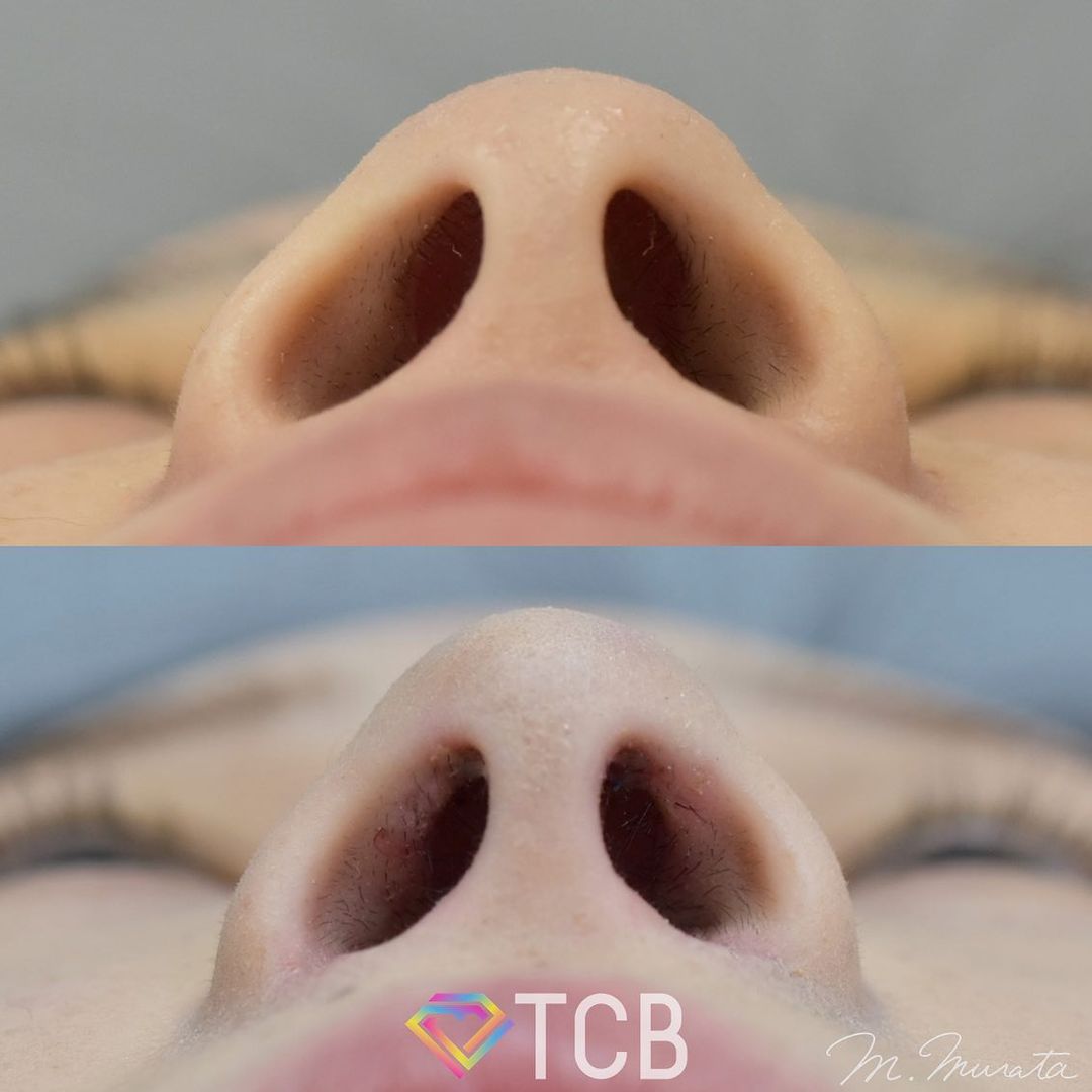 TCB式鼻翼縮小完全内側法の症例写真