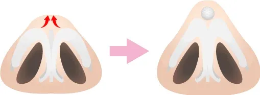 切らない鼻尖形成