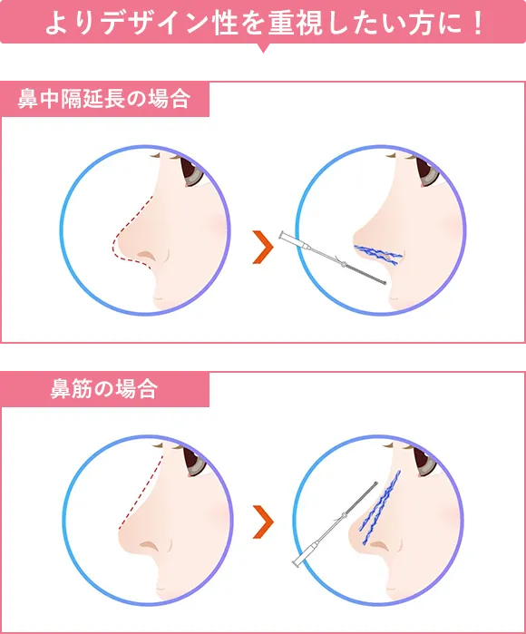 鼻のヒアルロン酸注射