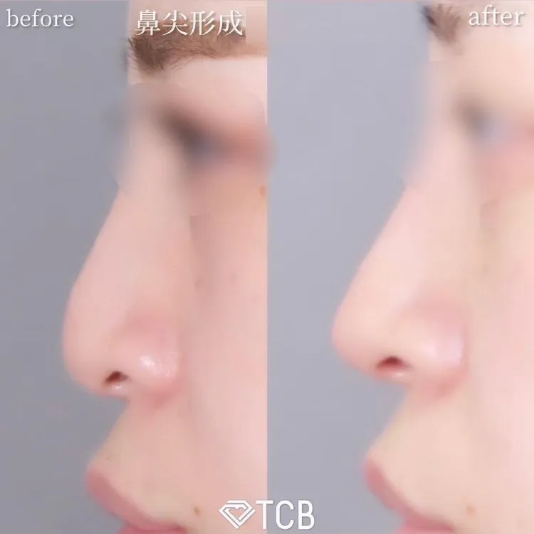 切らない鼻尖形成の症例写真