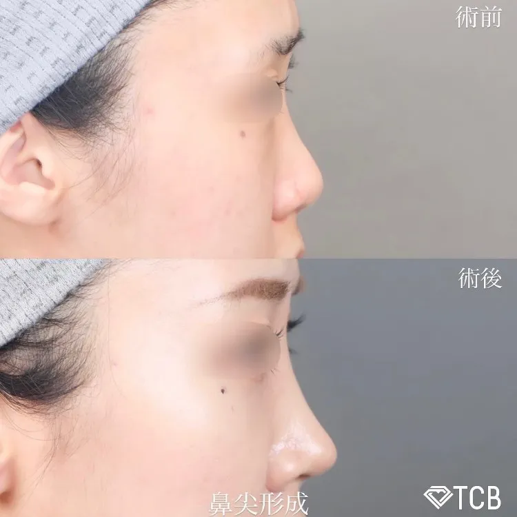 鼻尖形成+鼻中隔延長の症例写真