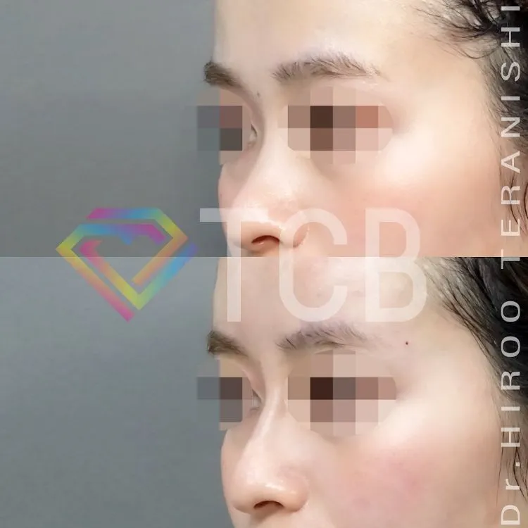 鼻のヒアルロン酸注射の症例写真