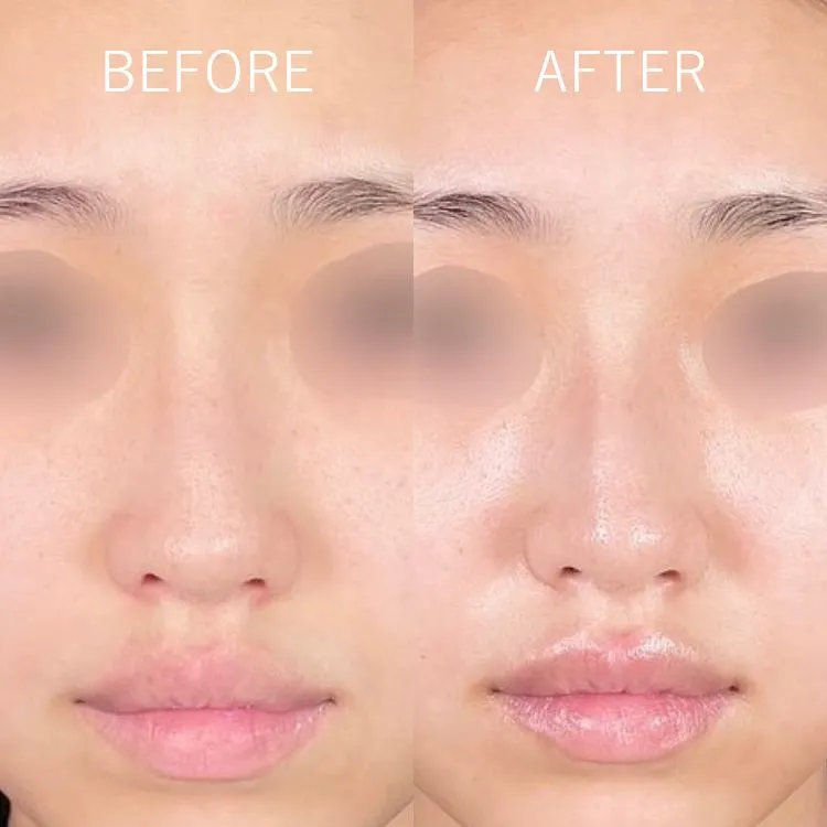 TCBメッシュの症例写真