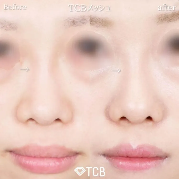 TCBメッシュの症例写真