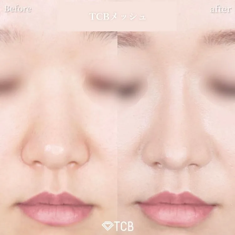 TCBメッシュの症例写真