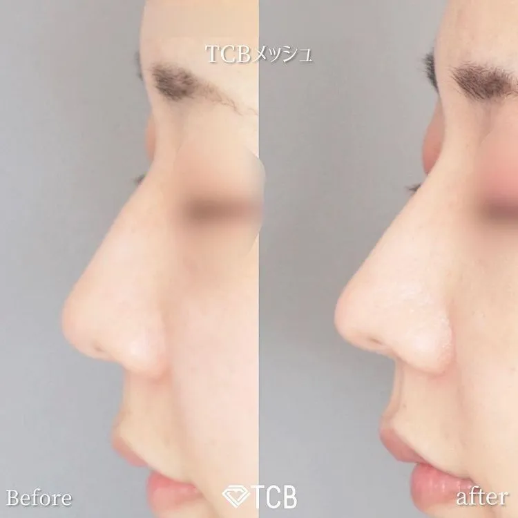 TCBメッシュの症例写真