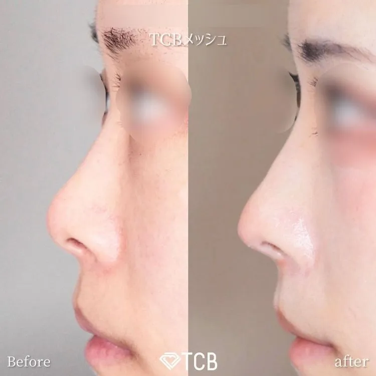 TCBメッシュの症例写真