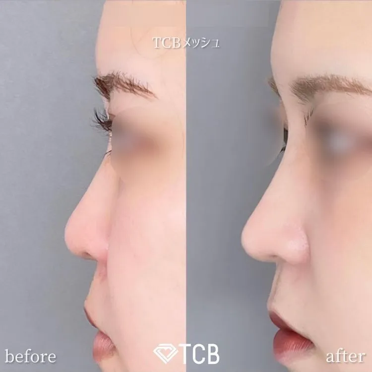 TCBメッシュの症例写真