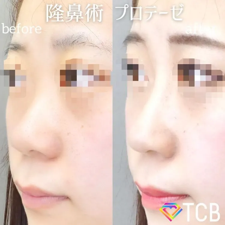 鼻プロテーゼの症例写真