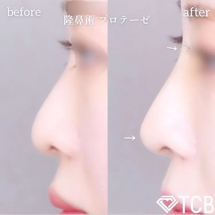 鼻プロテーゼの症例写真