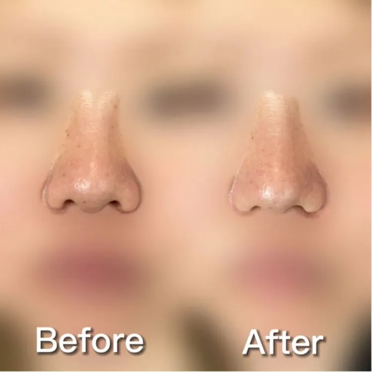 小鼻縮小の症例写真