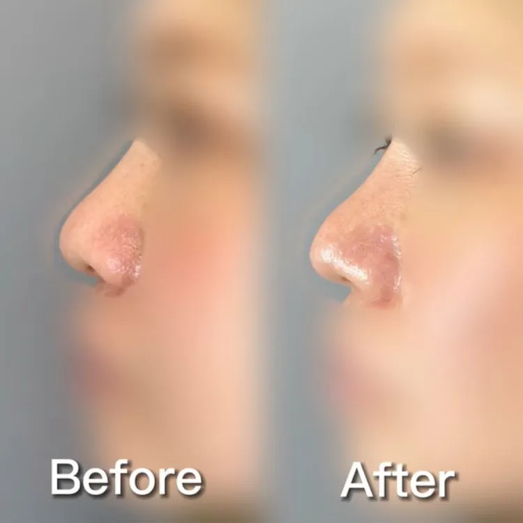 小鼻縮小の症例写真