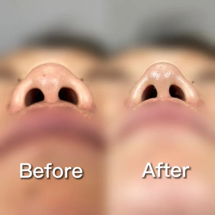 小鼻縮小の症例写真