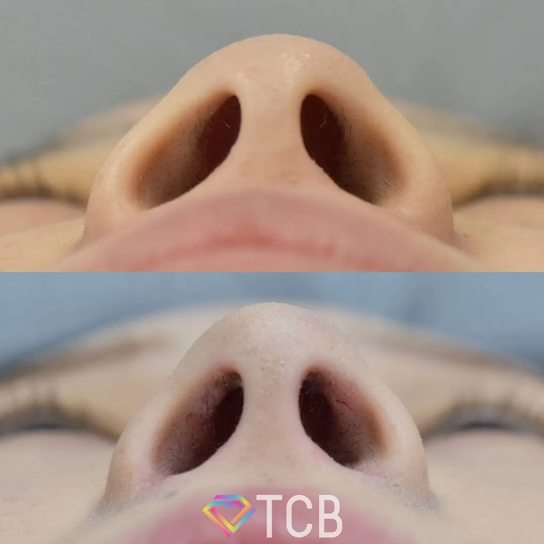 TCB式鼻翼縮小完全内側法の症例写真