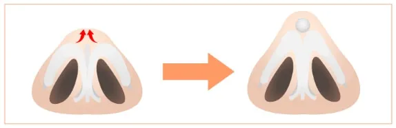 切らない鼻尖形成のイメージ