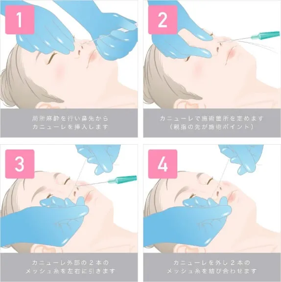 切らない鼻尖形成のイメージ