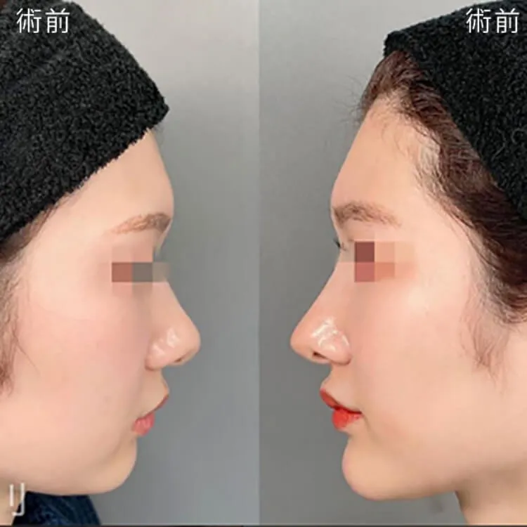 切らない鼻尖形成の症例写真