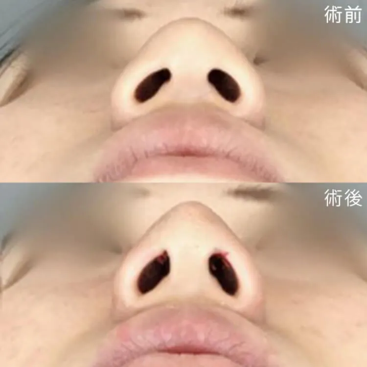 切らない鼻尖形成の症例写真