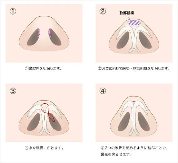 TCB鼻尖形成の症例写真