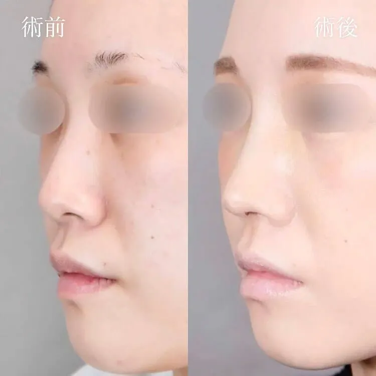 TCB鼻尖形成の症例写真