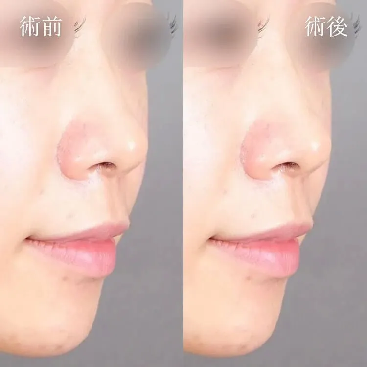 TCB鼻尖形成の症例写真