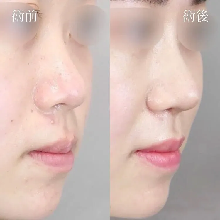 TCB鼻尖形成の症例写真