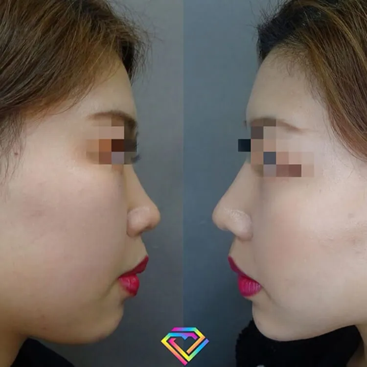 鼻のヒアルロン酸注射の症例写真