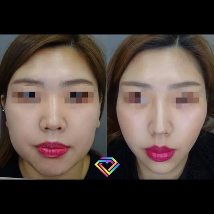 鼻のヒアルロン酸注射の症例写真