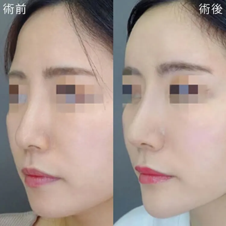 プロテーゼによる隆鼻術の症例写真