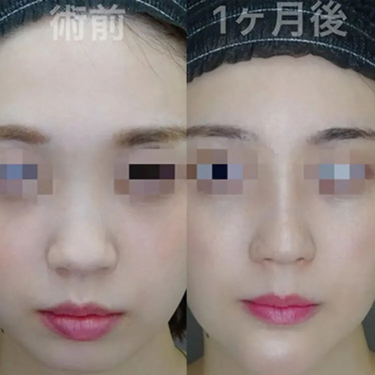 プロテーゼによる隆鼻術の症例写真