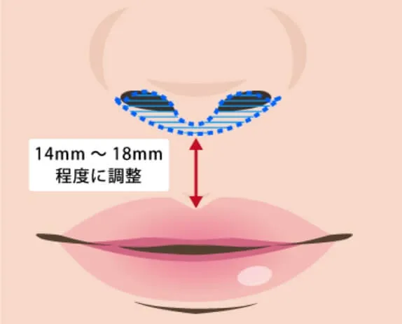 鼻筋を通して高くするだけでなく曲がってしまっている鼻も修正可能です。