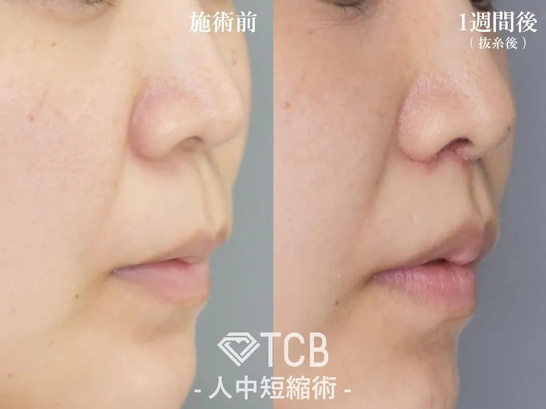 人中短縮の症状事例