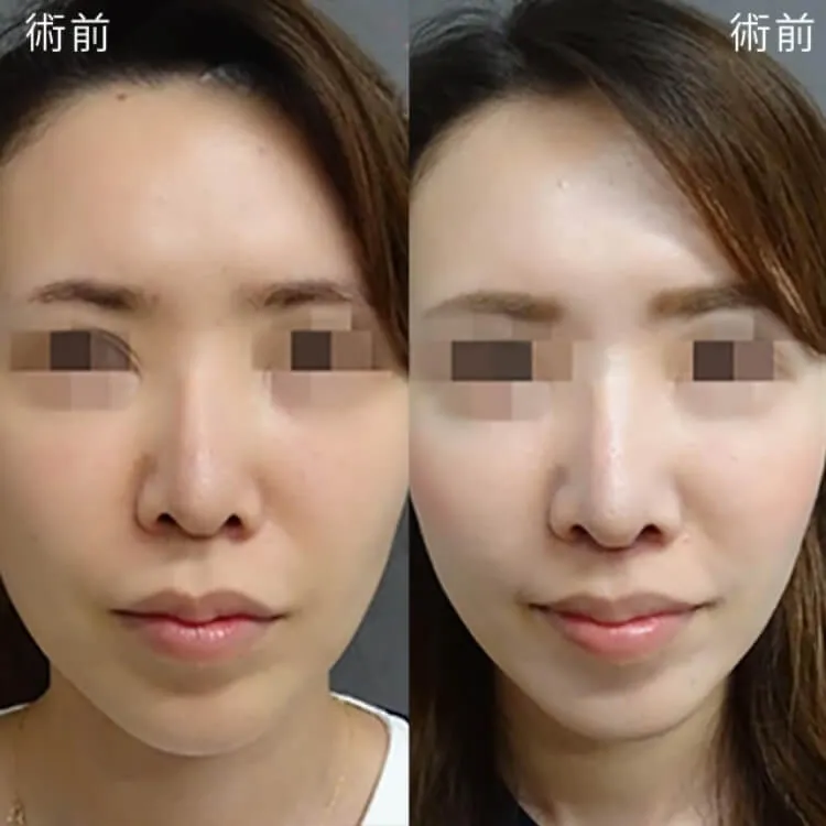 人中短縮の症例写真