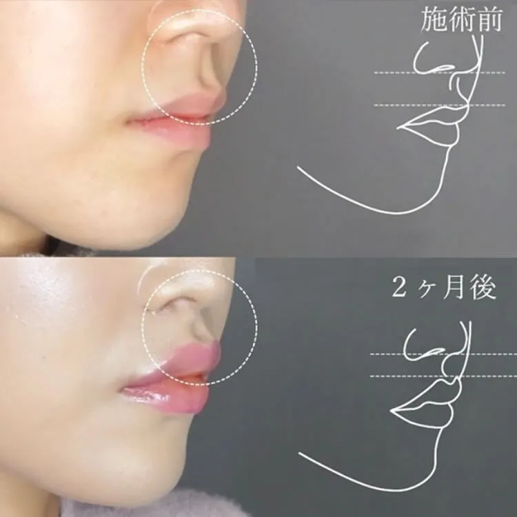 人中短縮の症例写真