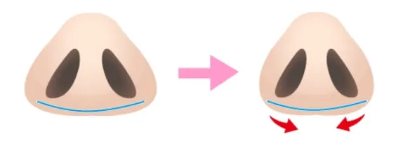 切らない小鼻縮小（鼻翼縮小埋没法）イメージ