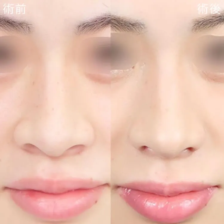 切らない小鼻縮小の症例写真
