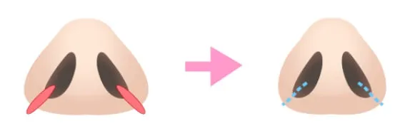 切らない小鼻縮小（鼻翼縮小埋没法）イメージ