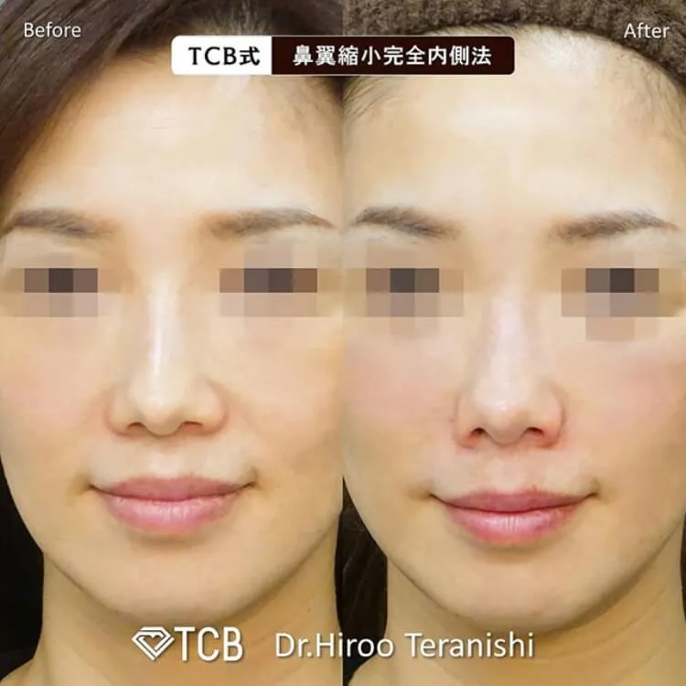 鼻の症例写真