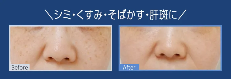 シミ・くすみ・そばかす・肝斑に