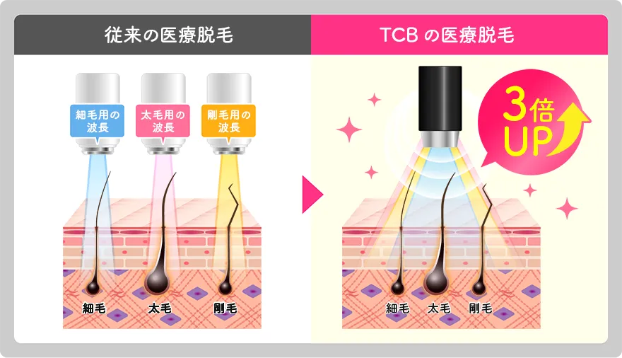 従来の医療脱毛とTCBの医療脱毛の違い