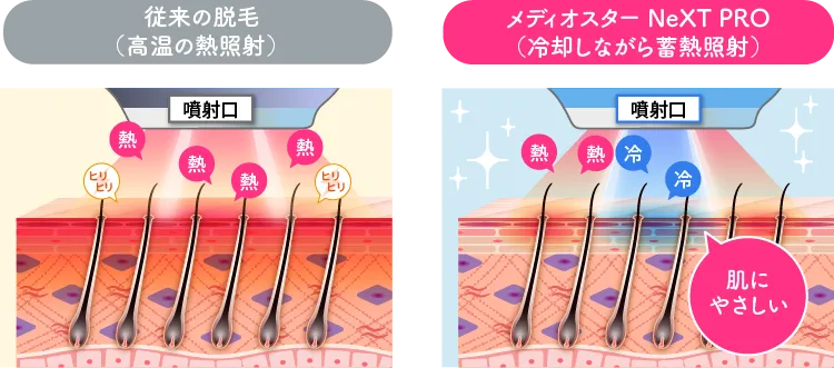 メディオスター NeXT PRO(冷却しながら蓄熱照射)